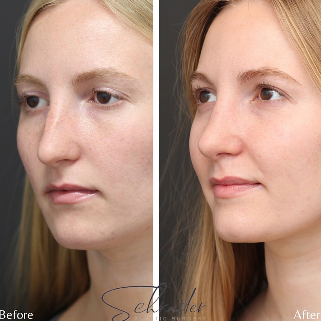 Schrader Facial Plastic Surgery | 256 Bunn Dr suite b, Princeton, NJ 08540 | Phone: (609) 279-0009
